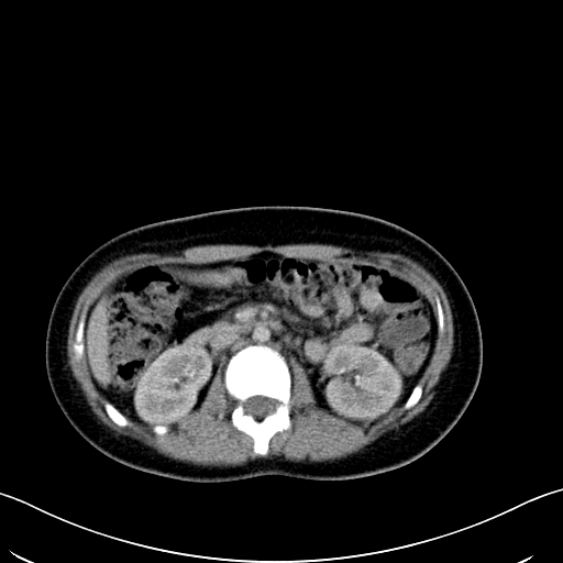 File:Caroli disease with medullary sponge kidney (Radiopaedia 82622-96804 C 31).jpg