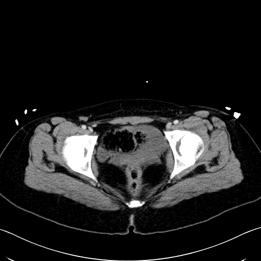 Caroli disease with medullary sponge kidney (Radiopaedia 82622-96804 C 72).jpg