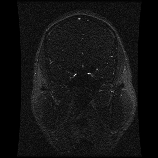 Carotid arterial dissection with acute cerebral infarction (Radiopaedia 26636-26784 MRV 114).jpg