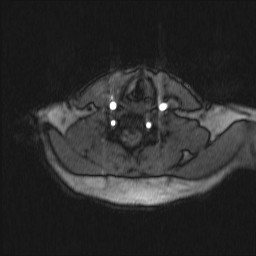 File:Carotid artery dissection (Radiopaedia 28441-28689 Axial MRA 24).jpg