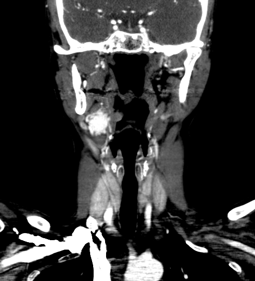 File:Carotid body tumor (Radiopaedia 39845-42300 C 10).jpg