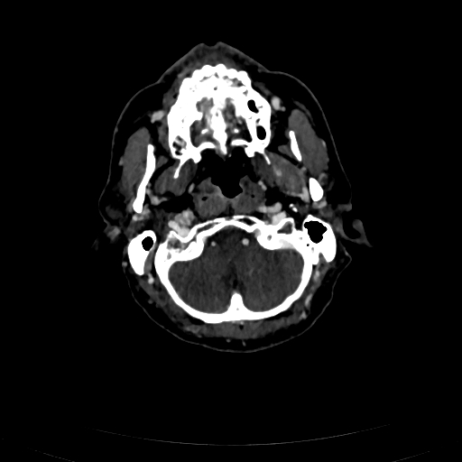 Carotid body tumor (Radiopaedia 83615-98727 D 30).jpg