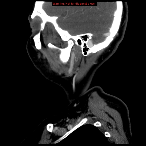 Carotid body tumor with lung metastases (Radiopaedia 9301-9986 Sagittal C+ delayed 7).jpg
