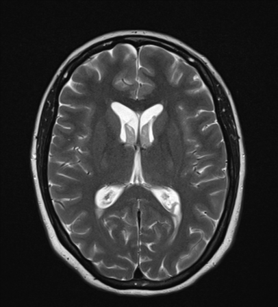 File:Cavernoma with bleed - midbrain (Radiopaedia 54546-60774 Axial T2 15).png