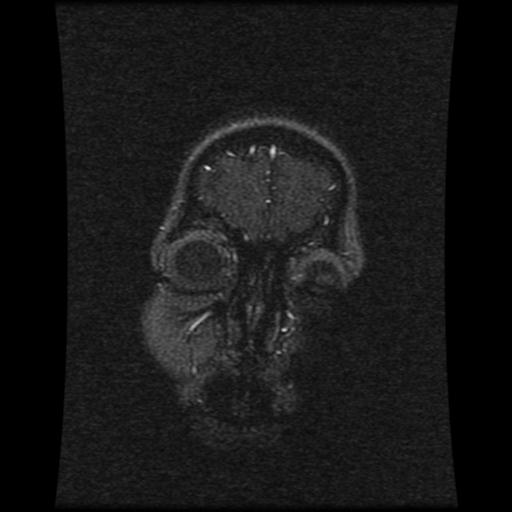 Cavernoma with developmental venous anomaly (Radiopaedia 22470-22507 MRV 116).jpg