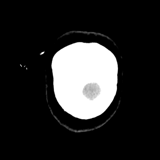 Cavernoma with hemorrhage (Radiopaedia 70755-80931 Coronal non-contrast 61).png