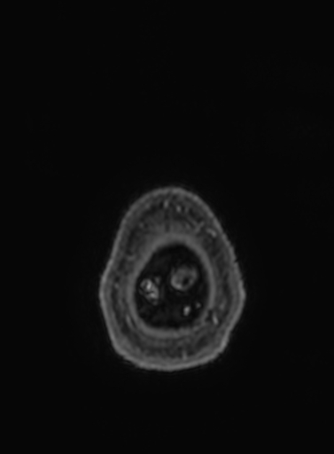 Cavernous hemangioma of the cerebellar falx (Radiopaedia 73025-83724 Axial T1 C+ 9).jpg