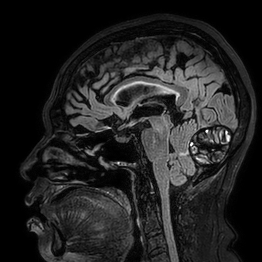 File:Cavernous hemangioma of the cerebellar falx (Radiopaedia 73025-83724 Sagittal FLAIR 111).jpg