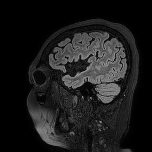 Cavernous hemangioma of the cerebellar falx (Radiopaedia 73025-83724 Sagittal FLAIR 34).jpg