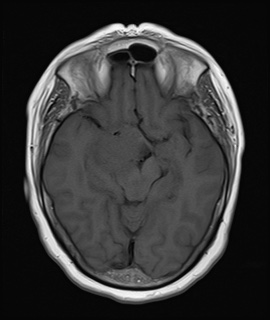File:Cavernous sinus meningioma (Radiopaedia 63682-72367 Axial T1 10).jpg