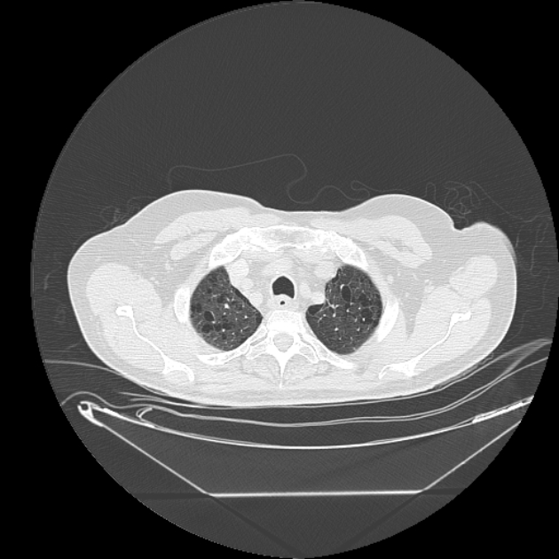 Cavitating bronchogenic carcinoma (Radiopaedia 44489-48162 Axial lung window 8).jpg