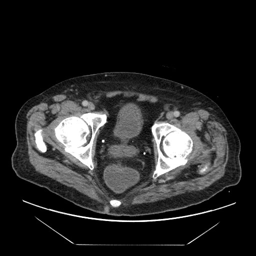 Cecal adenocarcinoma (Radiopaedia 64871-73817 A 91).jpg