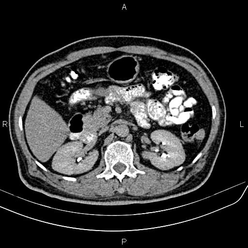 File:Cecal cancer with appendiceal mucocele (Radiopaedia 91080-108651 Axial C+ delayed 18).jpg