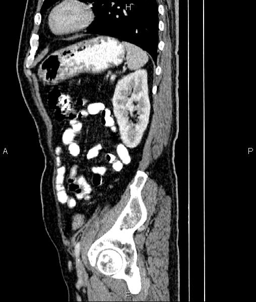 File:Cecal cancer with appendiceal mucocele (Radiopaedia 91080-108651 E 73).jpg