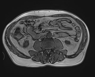 Cecal mass causing appendicitis (Radiopaedia 59207-66532 D 76).jpg