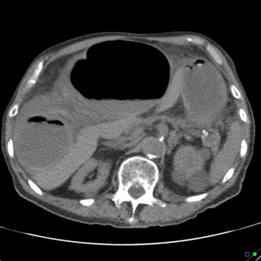 Cecal volvulus - atypical (Radiopaedia 21637-21588 non-contrast 23).jpg