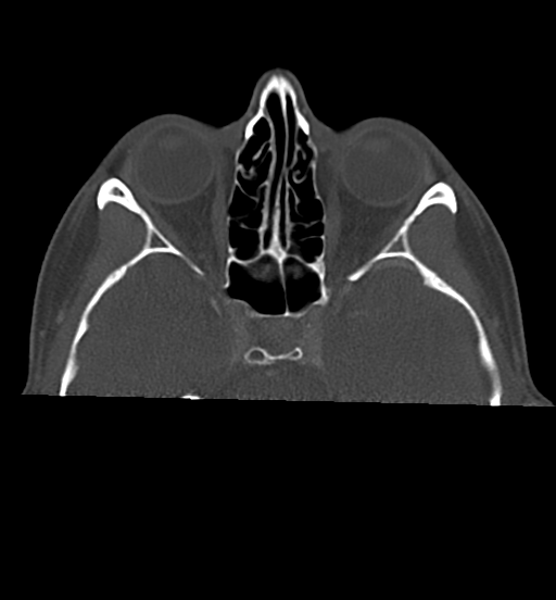 Cemento-ossifying fibroma (Radiopaedia 46243-50643 Axial bone window 18).png