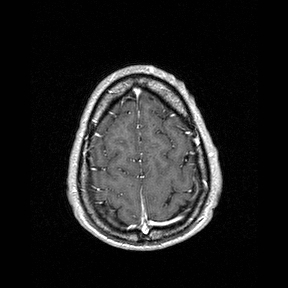 Central-variant posterior reversible encephalopathy syndrome (PRES) (Radiopaedia 43880-47358 Axial T1 C+ 148).jpg