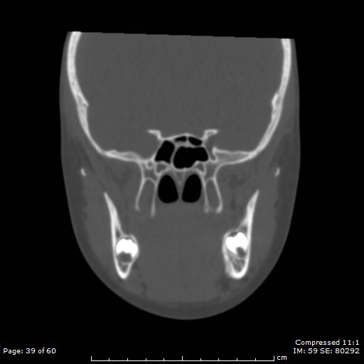Central giant cell granuloma (Radiopaedia 45612-49754 Coronal bone window 39).jpg