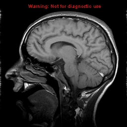 File:Central nervous system vasculitis (Radiopaedia 8410-9235 Sagittal T1 13).jpg