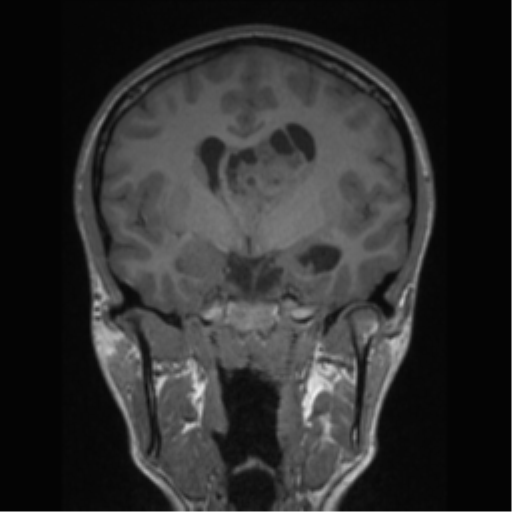 Central neurocytoma (Radiopaedia 37664-39557 Coronal T1 49).png