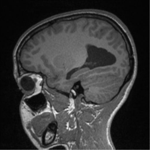 Central neurocytoma (Radiopaedia 37664-39557 Sagittal T1 31).png