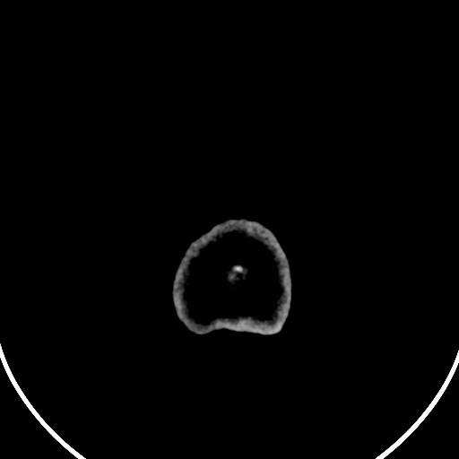 Central neurocytoma (Radiopaedia 84497-99871 Axial non-contrast 57).jpg