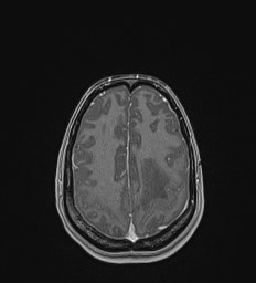 File:Central neurocytoma (Radiopaedia 84497-99872 Axial T1 C+ 121).jpg