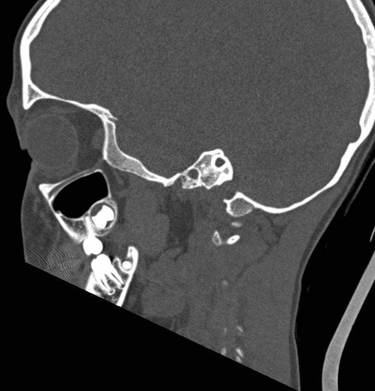 Cerebellar abscess (Radiopaedia 73727-84527 Sagittal bone window 1).jpg