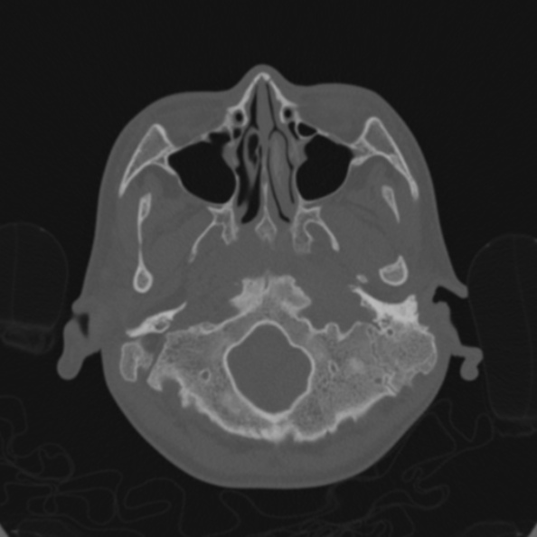 Cerebellar abscess secondary to mastoiditis (Radiopaedia 26284-26413 Axial bone window 24).jpg