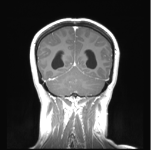 Cerebellar ependymoma complicated by post-operative subdural hematoma (Radiopaedia 83322-97736 Coronal T1 C+ 44).png