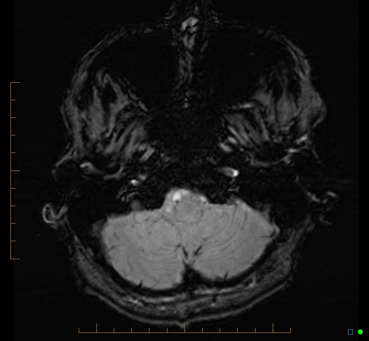 Cerebellar gangliocytoma (Radiopaedia 65377-74422 Axial SWI 7).jpg