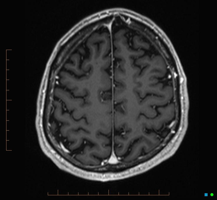 Cerebellar gangliocytoma (Radiopaedia 65377-74422 Axial T1 C+ 111).jpg