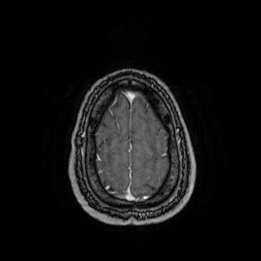 Cerebellar hemangioblastoma (Radiopaedia 88055-104622 Axial T1 C+ 153).jpg