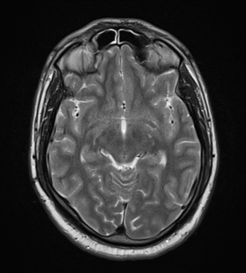 File:Cerebellar hemangioblastomas and pituitary adenoma (Radiopaedia 85490-101176 Axial T2 16).png