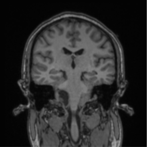 Cerebellar hemangioblastomas and pituitary adenoma (Radiopaedia 85490-101176 Coronal T1 43).png