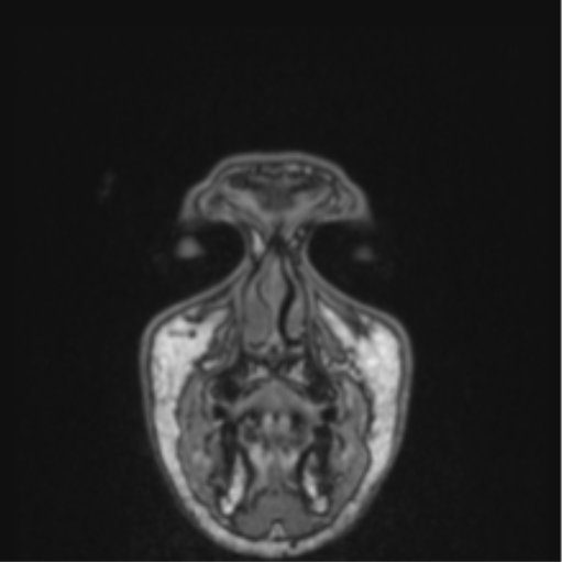 File:Cerebellar hemangioblastomas and pituitary adenoma (Radiopaedia 85490-101176 Coronal T1 90).png