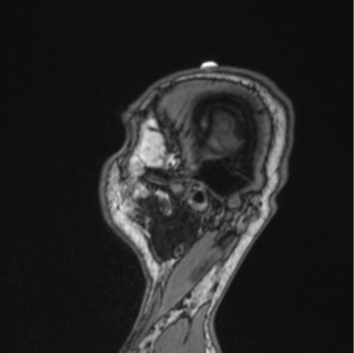 Cerebellar hemangioblastomas and pituitary adenoma (Radiopaedia 85490-101176 Sagittal T1 22).png