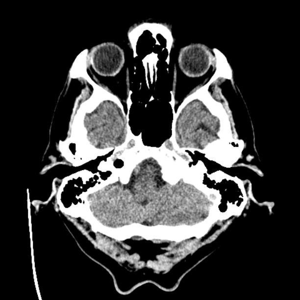 Cerebellar hemorrhage (Radiopaedia 27193-27359 Axial non-contrast 6).jpg