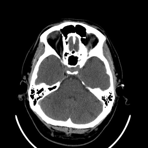 File:Cerebellar infarction (Radiopaedia 16625-16327 Axial non-contrast 12).jpg