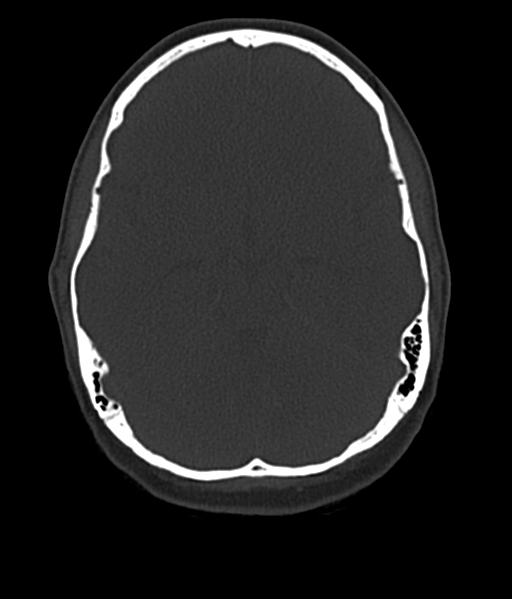 Cerebellar metastases - colorectal adenocarcinoma (Radiopaedia 40947-43652 AX Bone C- 2.0 MPR 22).png