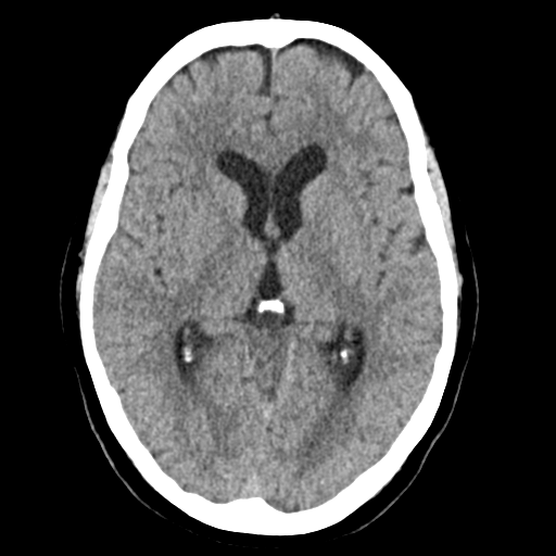 Cerebellar metastasis (Radiopaedia 54578-60812 Axial non-contrast 24).png