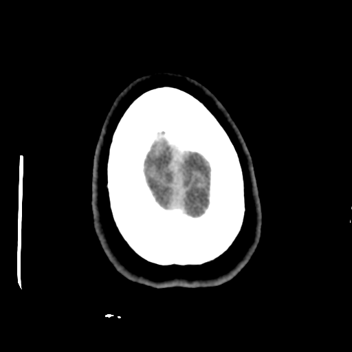 Cerebellar metastasis (cystic appearance) (Radiopaedia 41395-44258 Axial non-contrast 50).png