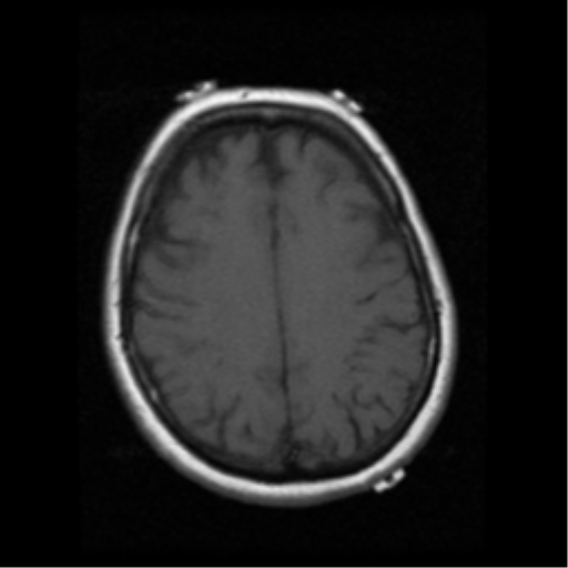 File:Cerebellar metastasis (cystic appearance) (Radiopaedia 41395-44262 Axial T1 16).png