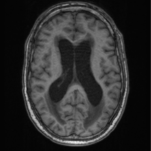 Cerebellar metastasis from lung adenocarcinoma (Radiopaedia 86690-102829 Axial T1 47).png