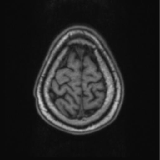 Cerebellar metastasis from lung adenocarcinoma (Radiopaedia 86690-102829 Axial T1 71).png