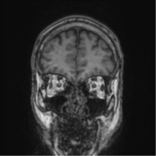 Cerebellar metastasis from lung adenocarcinoma (Radiopaedia 86690-102829 Coronal T1 81).png