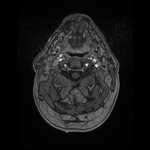Cerebellar metastasis of pulmonary adenocarcinoma, cavernous venous malformation, and developmental venous anomaly (Radiopaedia 85827-101661 Axial T1 C+ 5).jpg