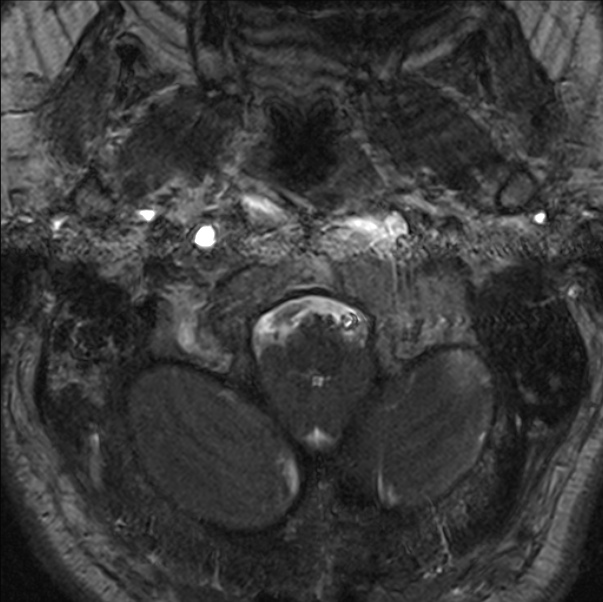 Cerebellopontine angle meningioma (Radiopaedia 24459-24764 I 2).jpg