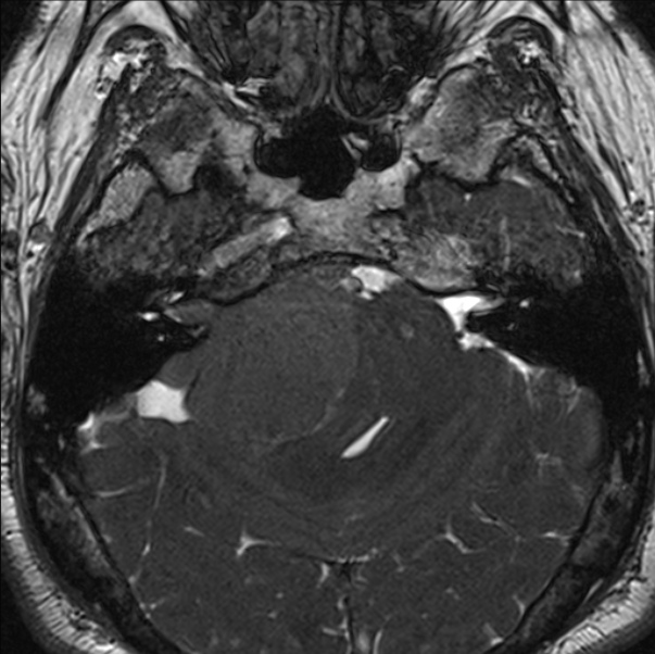 Cerebellopontine angle meningioma (Radiopaedia 24459-24764 I 24).jpg